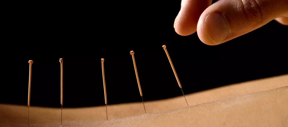 Fine acupuncture needles placed along a patient's back during a session.