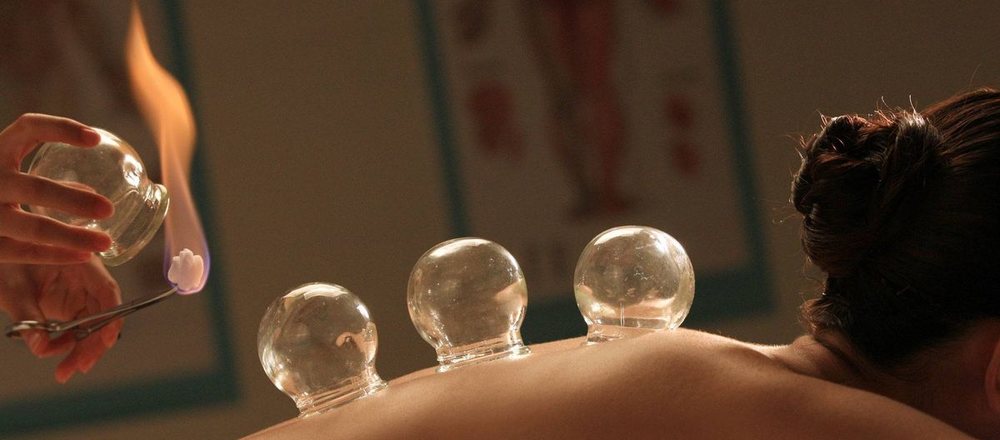 Glass cupping vessels set along a patient's upper back, with a practitioner warming the next cup.